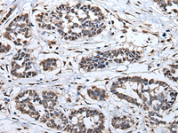 Immunohistochemistry of paraffin-embedded Human esophagus cancer tissue using HNRNPH2 Polyclonal Antibody at dilution of 1:40 (×200)
