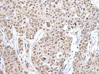 Immunohistochemistry of paraffin-embedded Human prost ate cancer tissue using HNRNPH2 Polyclonal Antibody at dilution of 1:40 (×200)