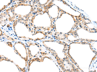 Immunohistochemistry of paraffin-embedded Human thyroid cancer tissue using SPACA3 Polyclonal Antibody at dilution of 1:45 (×200)