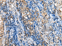 Immunohistochemistry of paraffin-embedded Human lung cancer tissue using MOB4 Polyclonal Antibody at dilution of 1:35 (×200)