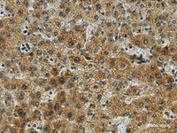 Immunohistochemistry of paraffin-embedded Human liver cancer tissue using LYPLA1 Polyclonal Antibody at dilution of 1:80 (×200)