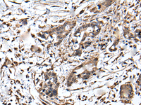 Immunohistochemistry of paraffin-embedded Human gastric cancer tissue using ZFP36 Polyclonal Antibody at dilution of 1:55 (×200)