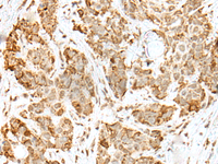 Immunohistochemistry of paraffin-embedded Human thyroid cancer tissue using ZKSCAN1 Polyclonal Antibody at dilution of 1:30 (×200)