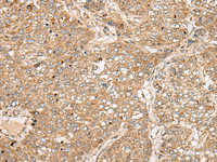 Immunohistochemistry of paraffin-embedded Human liver cancer tissue using TDGF1 Polyclonal Antibody at dilution of 1:50 (×200)