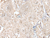 Immunohistochemistry of paraffin-embedded Human esophagus cancer tissue using VRK3 Polyclonal Antibody at dilution of 1:45 (×200)
