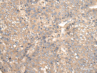 Immunohistochemistry of paraffin-embedded Human liver cancer tissue using VTI1B Polyclonal Antibody at dilution of 1:30 (×200)