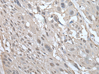 Immunohistochemistry of paraffin-embedded Human esophagus cancer tissue using UBE2W Polyclonal Antibody at dilution of 1:55 (×200)