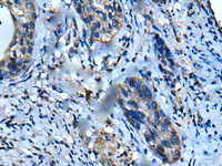 Immunohistochemistry of paraffin-embedded Human cervical cancer tissue using UFC1 Polyclonal Antibody at dilution of 1:50 (×200)