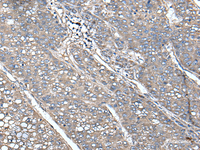 Immunohistochemistry of paraffin-embedded Human liver cancer tissue using UNC13B Polyclonal Antibody at dilution of 1:85 (×200)