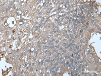 Immunohistochemistry of paraffin-embedded Human lung cancer tissue using UNC13B Polyclonal Antibody at dilution of 1:85 (×200)