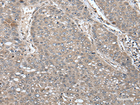 Immunohistochemistry of paraffin-embedded Human liver cancer tissue using UNC45B Polyclonal Antibody at dilution of 1:65 (×200)