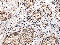 Immunohistochemistry of paraffin-embedded Human cervical cancer tissue using USP6NL Polyclonal Antibody at dilution of 1:30 (×200)