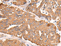 Immunohistochemistry of paraffin-embedded Human liver cancer tissue using ATP5C1 Polyclonal Antibody at dilution of 1:55 (×200)