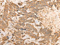 Immunohistochemistry of paraffin-embedded Human thyroid cancer tissue using BAIAP2L1 Polyclonal Antibody at dilution of 1:30 (×200)