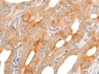 Immunohistochemistry of paraffin-embedded Human thyroid cancer tissue using BBOX1 Polyclonal Antibody at dilution of 1:50 (×200)