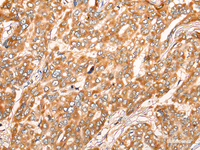 Immunohistochemistry of paraffin-embedded Human liver cancer tissue using ZMYND10 Polyclonal Antibody at dilution of 1:35 (×200)