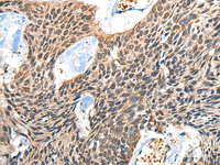 Immunohistochemistry of paraffin-embedded Human esophagus cancer tissue using BOLA1 Polyclonal Antibody at dilution of 1:50 (×200)