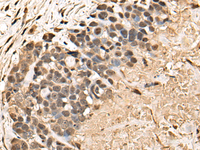 Immunohistochemistry of paraffin-embedded Human thyroid cancer tissue using BUD31 Polyclonal Antibody at dilution of 1:45 (×200)