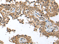 Immunohistochemistry of paraffin-embedded Human ovarian cancer tissue using SPRTN Polyclonal Antibody at dilution of 1:65 (×200)