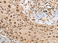 Immunohistochemistry of paraffin-embedded Human lung cancer tissue using RTCB Polyclonal Antibody at dilution of 1:45 (×200)