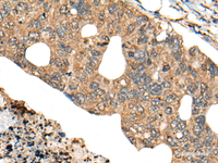 Immunohistochemistry of paraffin-embedded Human colorectal cancer tissue using PPP3R1 Polyclonal Antibody at dilution of 1:80 (×200)