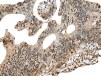 Immunohistochemistry of paraffin-embedded Human colorectal cancer tissue using CALML5 Polyclonal Antibody at dilution of 1:90 (×200)