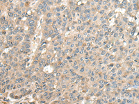 Immunohistochemistry of paraffin-embedded Human liver cancer tissue using CASQ1 Polyclonal Antibody at dilution of 1:100 (×200)