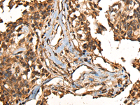 Immunohistochemistry of paraffin-embedded Human ovarian cancer tissue using CAMKK1 Polyclonal Antibody at dilution of 1:35 (×200)