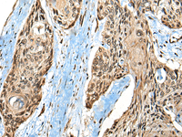 Immunohistochemistry of paraffin-embedded Human esophagus cancer tissue using CASK Polyclonal Antibody at dilution of 1:65 (×200)