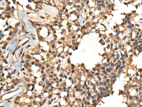 Immunohistochemistry of paraffin-embedded Human ovarian cancer tissue using CASK Polyclonal Antibody at dilution of 1:65 (×200)