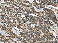 Immunohistochemistry of paraffin-embedded Human lung cancer tissue using MICU1 Polyclonal Antibody at dilution of 1:35 (×200)