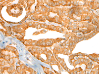 Immunohistochemistry of paraffin-embedded Human thyroid cancer tissue using CEP72 Polyclonal Antibody at dilution of 1:40 (×200)