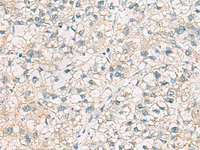 Immunohistochemistry of paraffin-embedded Human liver cancer tissue using CHMP6 Polyclonal Antibody at dilution of 1:65 (×200)