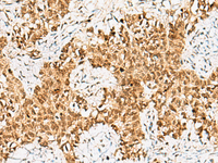 Immunohistochemistry of paraffin-embedded Human ovarian cancer tissue using CRCP Polyclonal Antibody at dilution of 1:65 (×200)