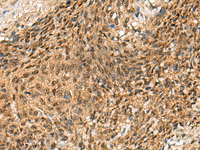 Immunohistochemistry of paraffin-embedded Human cervical cancer tissue using CRCP Polyclonal Antibody at dilution of 1:65 (×200)