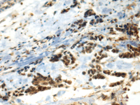 Immunohistochemistry of paraffin-embedded Human breast cancer tissue using DDX39A Polyclonal Antibody at dilution of 1:70 (×200)
