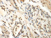Immunohistochemistry of paraffin-embedded Human thyroid cancer tissue using DDX39A Polyclonal Antibody at dilution of 1:70 (×200)