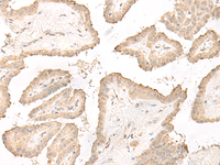 Immunohistochemistry of paraffin-embedded Human thyroid cancer tissue using DCD Polyclonal Antibody at dilution of 1:35 (×200)