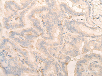 Immunohistochemistry of paraffin-embedded Human thyroid cancer tissue using PITPNB Polyclonal Antibody at dilution of 1:25 (×200)