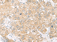 Immunohistochemistry of paraffin-embedded Human liver cancer tissue using SH3GL2 Polyclonal Antibody at dilution of 1:45 (×200)