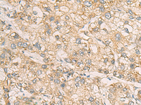 Immunohistochemistry of paraffin-embedded Human liver cancer tissue using STX5 Polyclonal Antibody at dilution of 1:70 (×200)