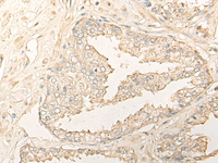 Immunohistochemistry of paraffin-embedded Human prost at e cancer tissue using DIMT1 Polyclonal Antibody at dilution of 1:35 (×200)