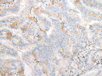 Immunohistochemistry of paraffin-embedded Human thyroid cancer tissue using TMEM248 Polyclonal Antibody at dilution of 1:25 (×200)
