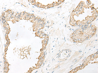 Immunohistochemistry of paraffin-embedded Human prost ate cancer tissue using DHRS7 Polyclonal Antibody at dilution of 1:30 (×200)