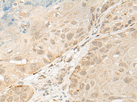 Immunohistochemistry of paraffin-embedded Human esophagus cancer tissue using OTX1 Polyclonal Antibody at dilution of 1:30 (×200)