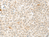 Immunohistochemistry of paraffin-embedded Human ovarian cancer tissue using OTX1 Polyclonal Antibody at dilution of 1:30 (×200)