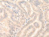 Immunohistochemistry of paraffin-embedded Human thyroid cancer tissue using HMBS Polyclonal Antibody at dilution of 1:25 (×200)