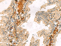 Immunohistochemistry of paraffin-embedded Human prost at e cancer tissue using ACTC1 Polyclonal Antibody at dilution of 1:65 (×200)