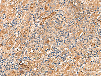 Immunohistochemistry of paraffin-embedded Human liver cancer tissue using DNAJC14 Polyclonal Antibody at dilution of 1:70 (×200)