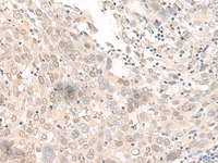 Immunohistochemistry of paraffin-embedded Human prost at e cancer tissue using OLA1 Polyclonal Antibody at dilution of 1:45 (×200)